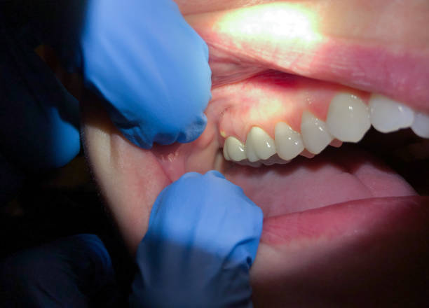 Best Knocked-Out Tooth (Avulsed Tooth) Treatment in South Bay, FL